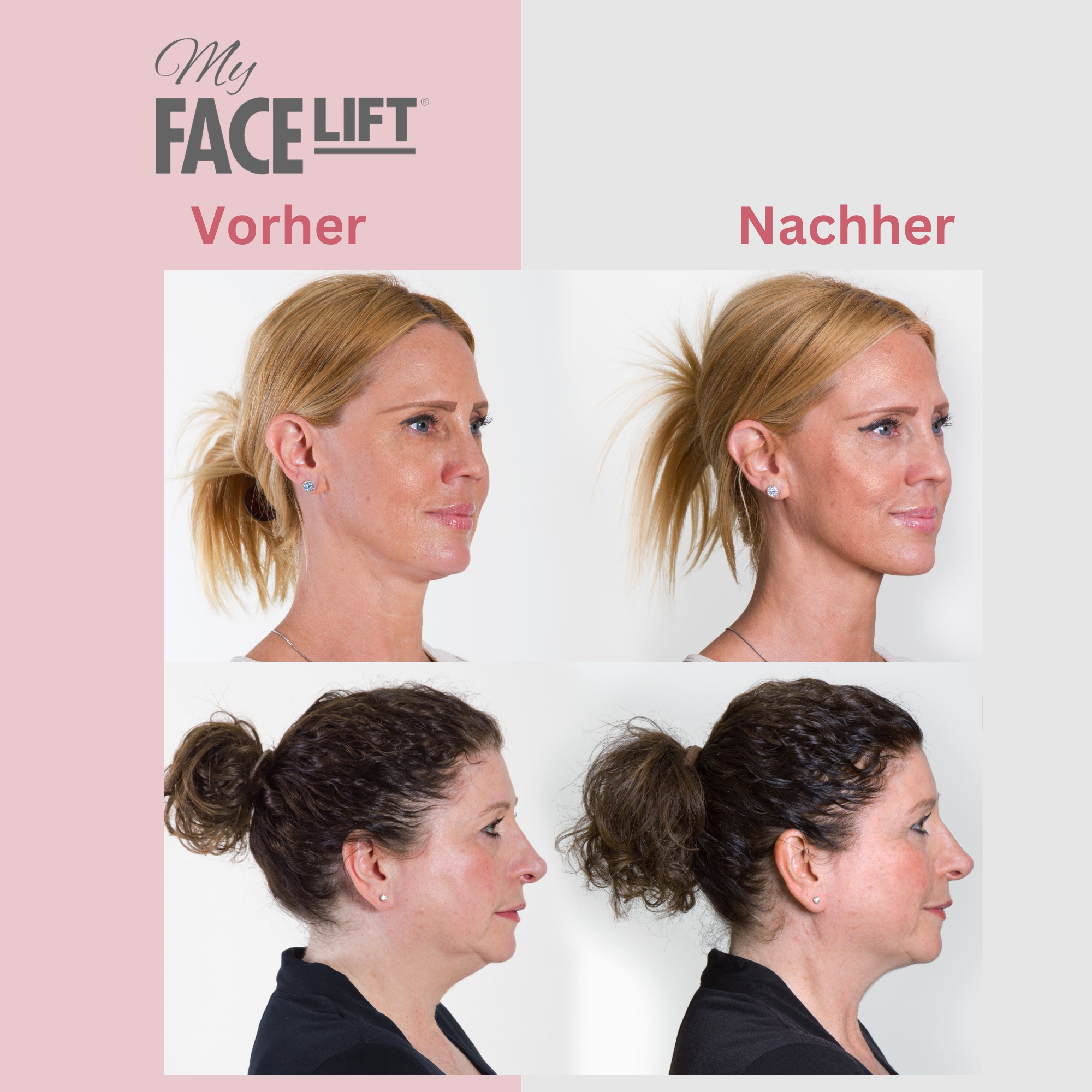 My Face Lift