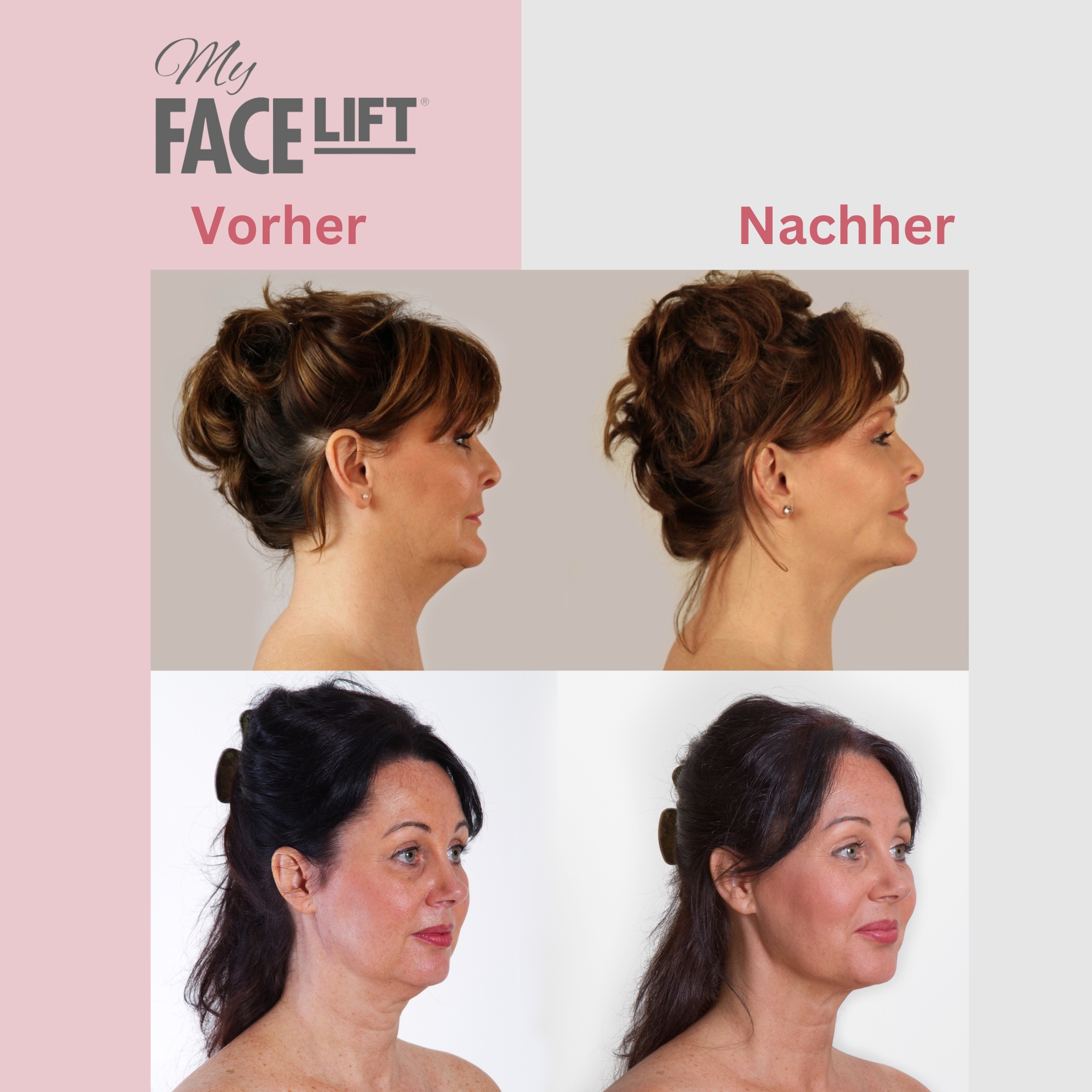 My Face Lift